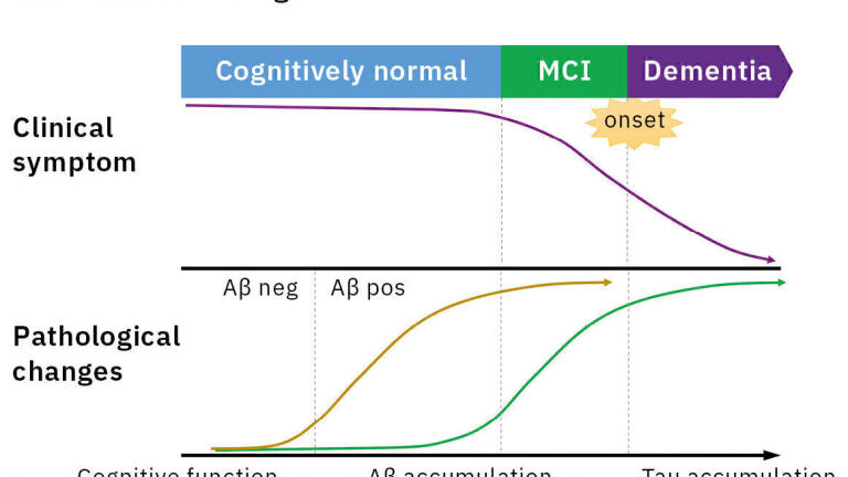 MS detection of Alzheimer’s blood-based biomarkers - From a few drops of blood - the first successful detection of plasma Aβ by MS