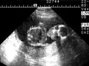 Nanoscale ultrasound makes science news headlines