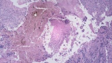 Fatal skin cancer rates 'higher in men'