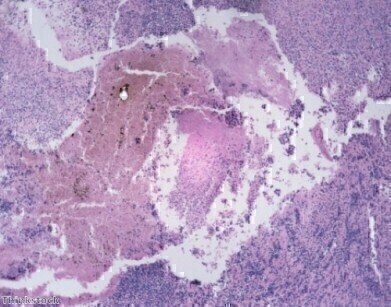 Fatal skin cancer rates 'higher in men'