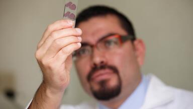 NICE recommends Test for patients with Lung Cancer