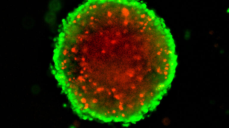 3D Spheroid Assays for Cancer Drug Screening