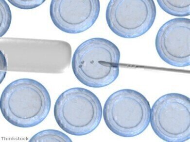 Gene variant links MCI to brain atrophy 