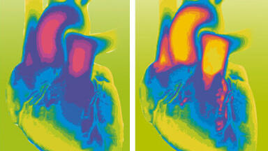 Diagnosing heart failure with extended VIDAS® Galectin-3 Menu