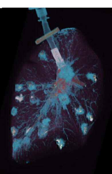 Probe speeds detection of deep lung infections in Patients