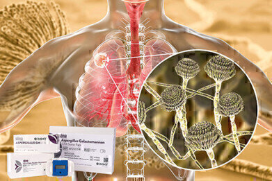 Invasive Aspergillosis Screening in COVID-19 and Critical Care Patients