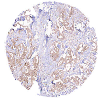 Custom monoclonal antibody reveals HER2+ breast cancer target