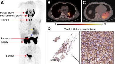 Novel radiotracer identifies critical cancer biomarker, opens door to new therapeutic target for solid tumours