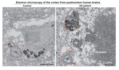 Researchers identify key cellular mechanism driving progression of Alzheimer’s disease