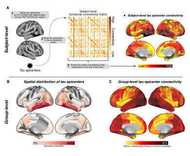 Detangling tau: Patient scans reveal how amyloid and tau proteins work in tandem in Alzheimer’s disease