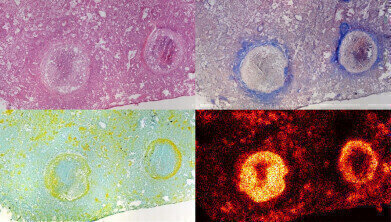 Tuberculosis bacteria hiding in dead lung tissue can be treated by novel antibiotic