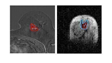 Breakthrough scanner detects hidden cancer spread