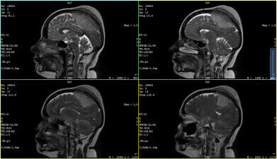 Biomarker found that predicts a cancer’s ‘aggressiveness’