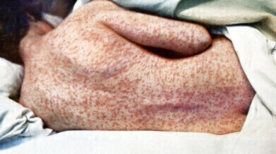 US measles outbreak: is it the next pandemic’s pathogen of choice?