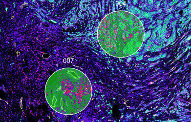 Finnish study identifies gene test to guide cancer immunotherapy