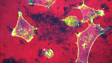 Visual breakthrough targets breast cancer spread