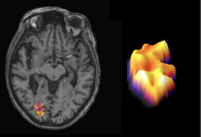 New biomarker offers hope for predicting multiple sclerosis progression