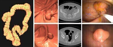 CT colonography outperforms stool DNA screening for colorectal cancer 