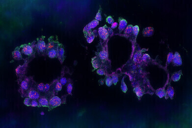 Link to triple-negative breast cancer identified in RNA study