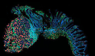 Preventing chronic inflammation from progressing to cancer of the bowel