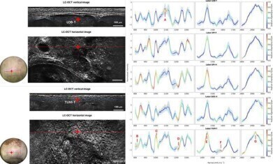 Dual-mode optical imaging system enables noninvasive skin cancer characterisation