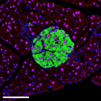 Single-gene linked to widespread type-2 diabetes via RNA disruption in insulin-producing cells