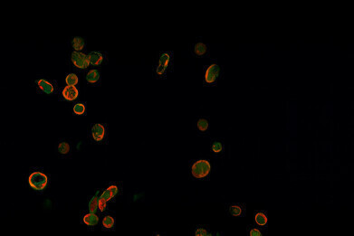 Discovery of platelet protein could reduce heart attack and stroke risk in people with type 2 diabetes