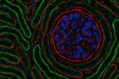 PathoPlex tech maps protein patterns to detect kidney stress in type 2 diabetes
