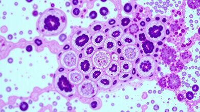 Mutant p53 drives anti-oestrogen therapy resistance in ovarian cancer