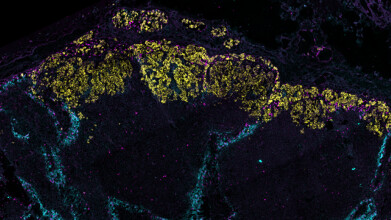 Breast cancer remodels lymphatic vessels to spread