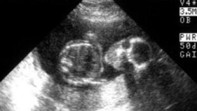 Two Successfully Integrated Systems for Lyophilisation of Pharmaceutical Products